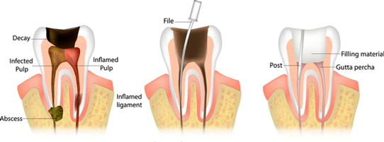 Three-panel dental root canal sequence: decay reaching the pulp with abscess; cleaning with a file to remove infected tissue; sealing with gutta-percha and a post.