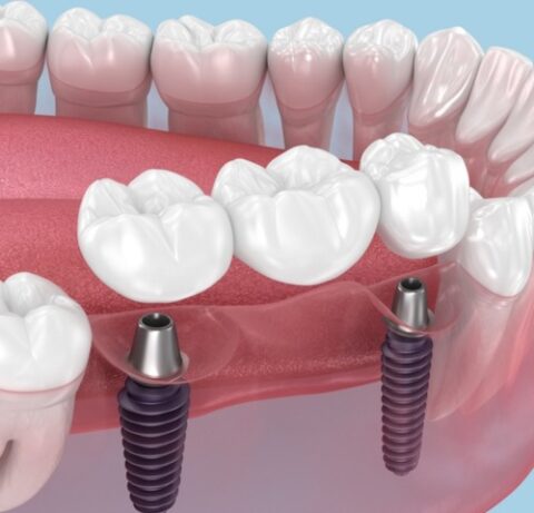Dental Crowns and Bridges Treatment at The Smile Connect Kandivali - The Smile Connect Dental Crowns and Bridges Treatment at The Smile Connect Kandivali