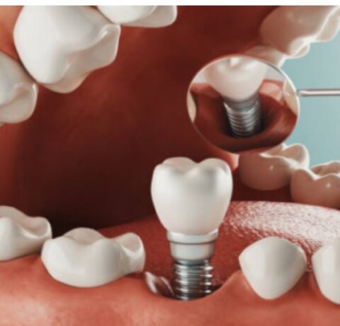 Dental Implant Treatment in Kandivali at The Smile Connect Clinic - The Smile Connect Dental Implant Treatment in Kandivali at The Smile Connect Clinic