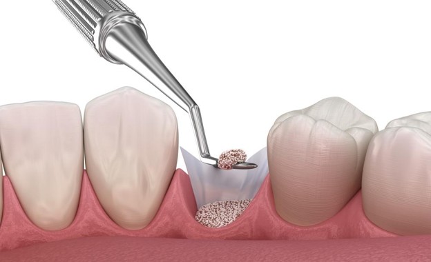 Picture1 - The Smile Connect Dental procedure: a graft material is being placed into a tooth socket between two adjacent teeth, with a dental instrument nearby.