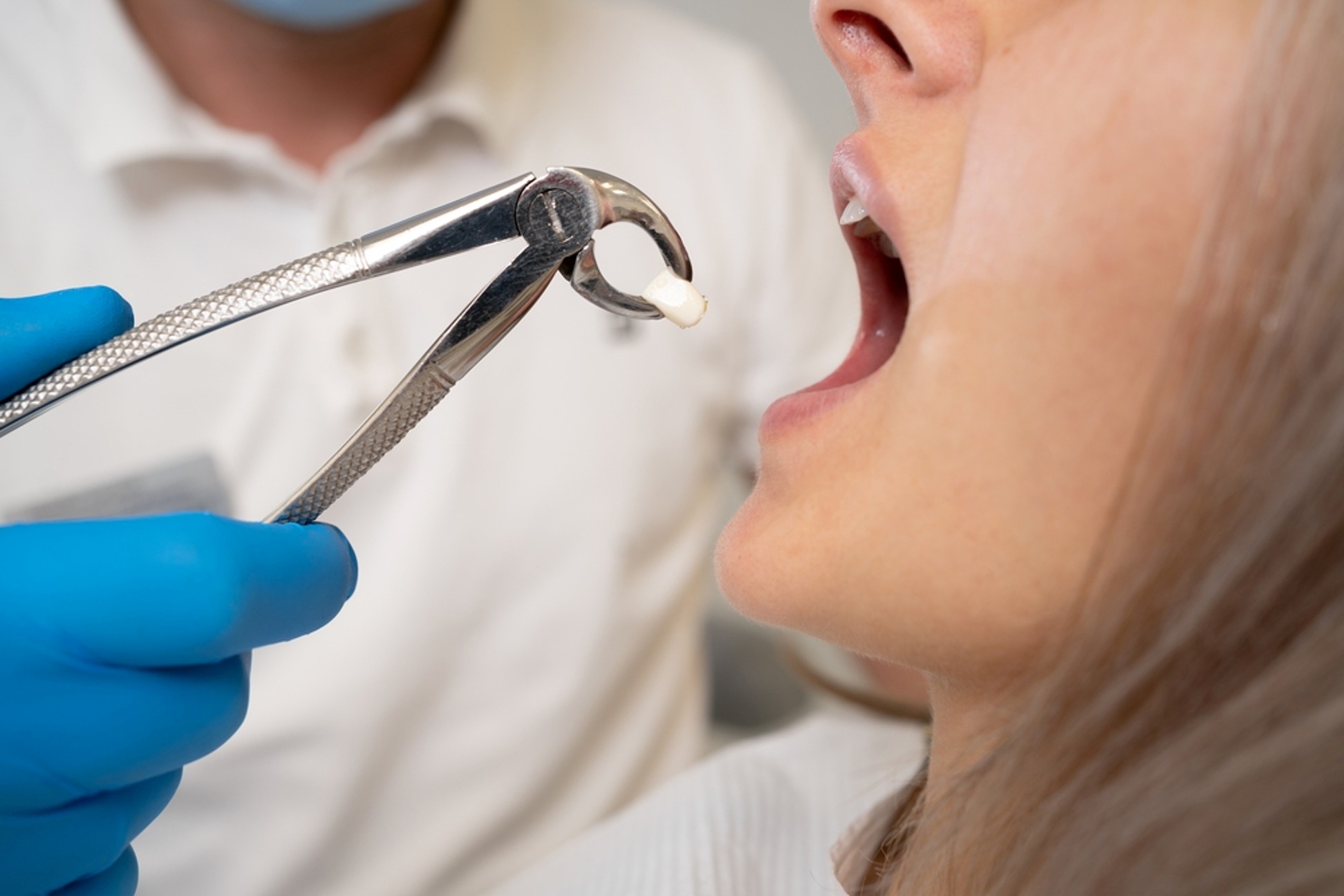 Picture2 - The Smile Connect Close-up of a dentist in blue gloves placing a tooth crown into a patient’s open mouth, using precision dental tools.
