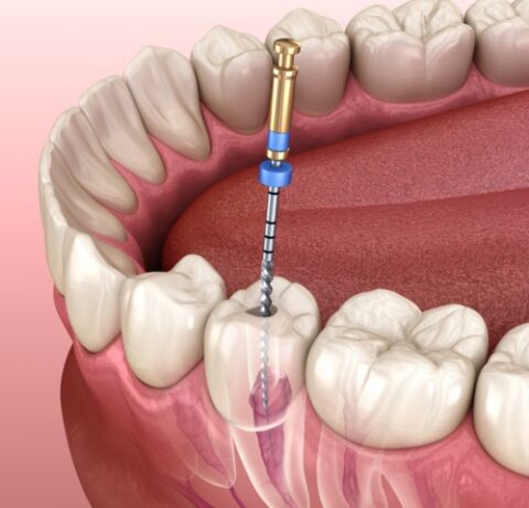 Root Canal Treatment in Kandivali at The Smile Connect Clinic - The Smile Connect Root Canal Treatment in Kandivali at The Smile Connect Clinic