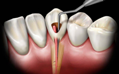 Root Canal Pain After a Year: Causes, Diagnosis & Treatment