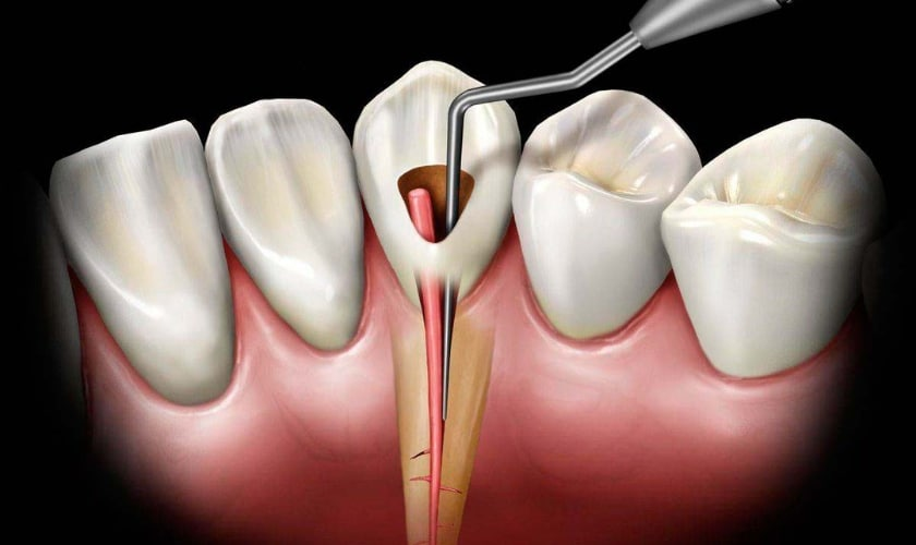 Root Canal Pain After a Year: Causes, Diagnosis & Treatment