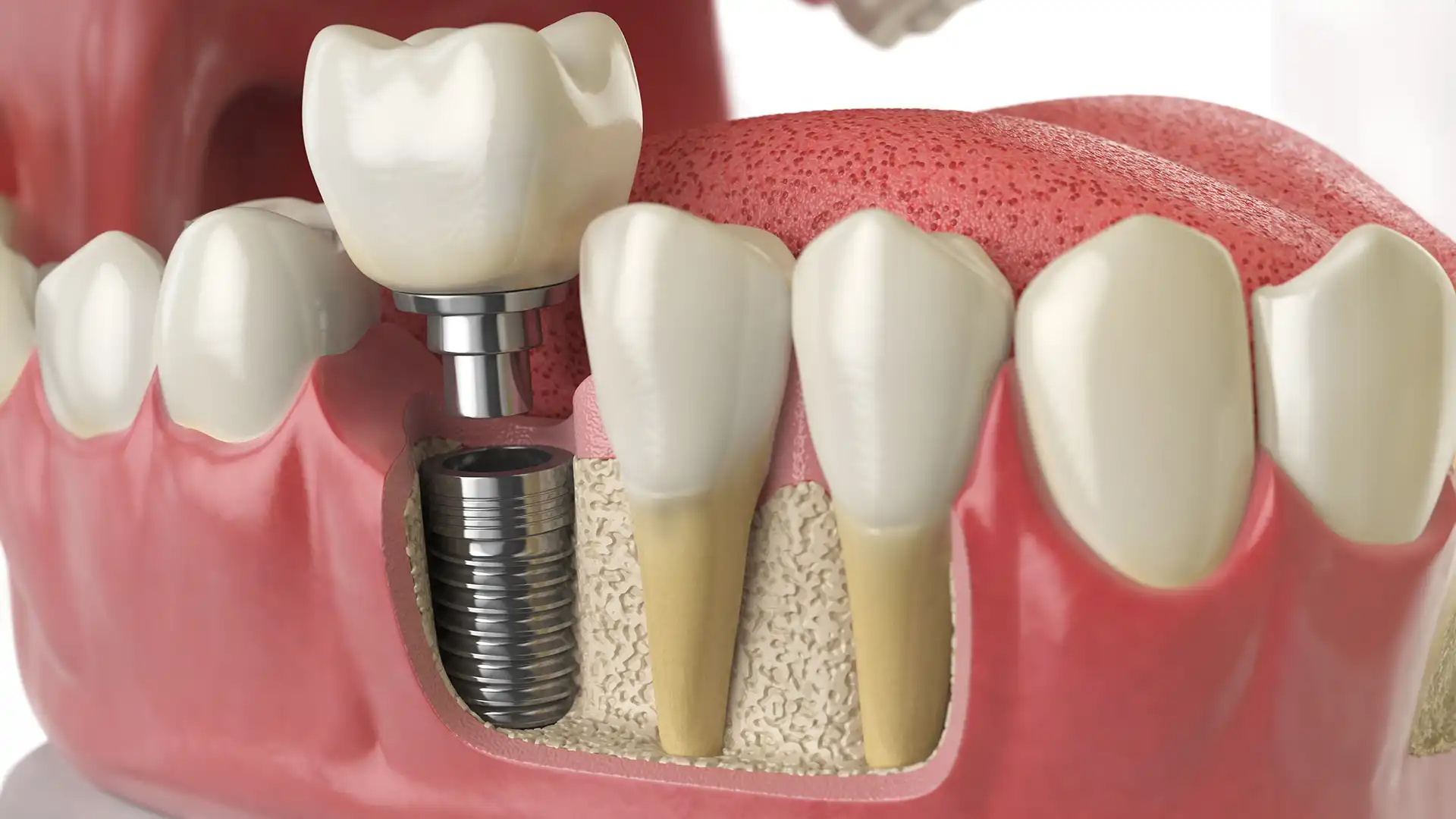 Dental Bone Graft - The Smile Connect Dental illustration of a bone graft and membrane placed on the upper jaw near a tooth, with a surgical instrument above.