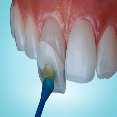 Dental Venture 1 - The Smile Connect Close-up of front teeth during a dental procedure; a blue applicator applies gel to a tooth near the gum line.
