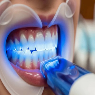 Teeth Whitening in Kandivali - The Smile Connect Close-up of a dental patient’s opened mouth during whitening, with cheek retractors and a blue curing light.