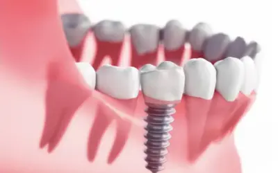 Why Does a Root Canal Tooth Need a Crown?