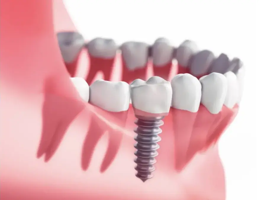 Why Does a Root Canal Tooth Need a Crown?