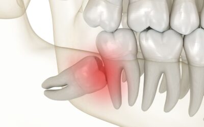 Wisdom Teeth Removal After Age 30