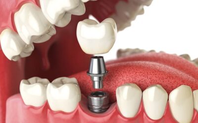 Dental Implants With Bone Loss?