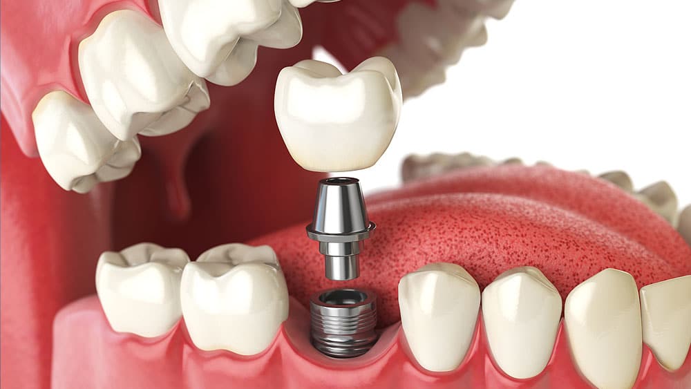 Lower jaw model showing a titanium dental implant being fitted with a crown