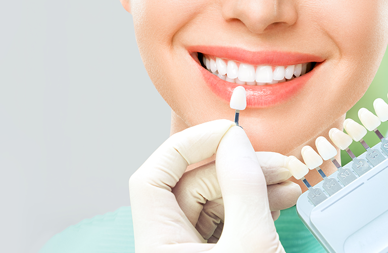f8ee23f4-3381-4274-912e-2682ce8acf46 - The Smile Connect Dentist's gloved hand holds a shade guide tooth up to a smiling woman's teeth during whitening.