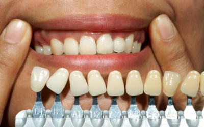 Tooth Bonding for Discolored Teeth