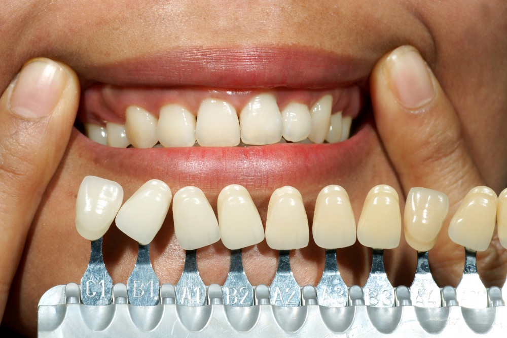 Close-up of a smiling mouth with a tooth shade guide held against the upper front teeth to compare color, showing tabs labeled A1 through B4.