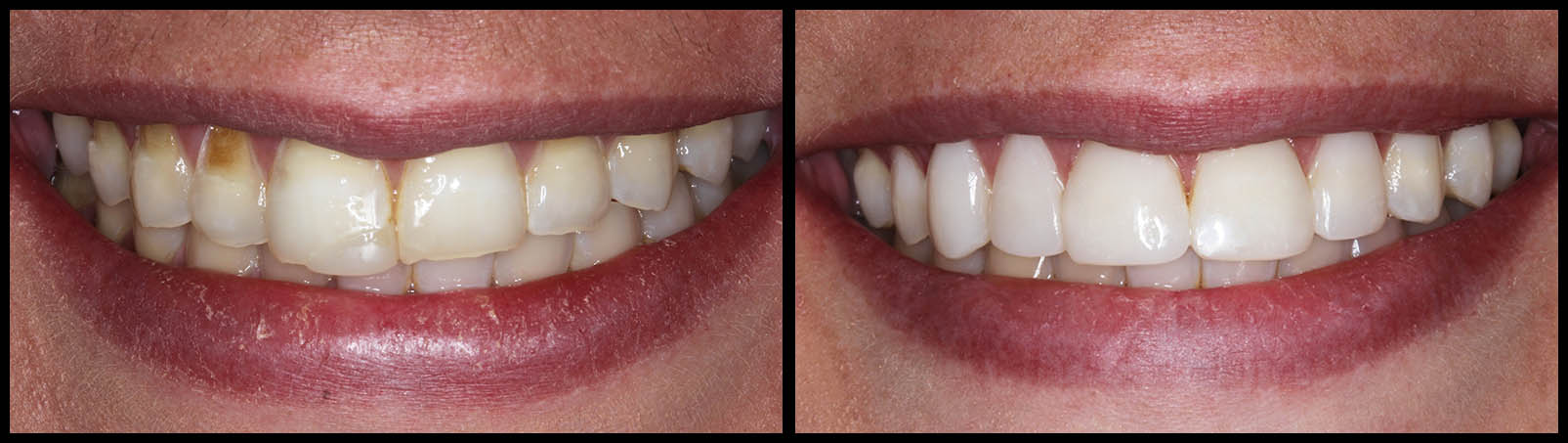 image2 - The Smile Connect Comparison photo of a smile: stained, crowded teeth on the left and whiter, more evenly aligned teeth on the right after cosmetic treatment.