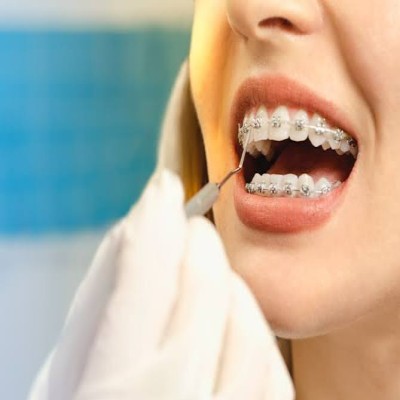 tooth alignment 1 - The Smile Connect Close-up of a patient's mouth with braces while a dental tool works on them during a procedure