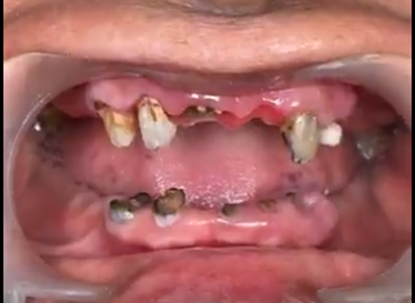 Close-up of a mouth with severe tooth decay and missing teeth, showing damaged gums.