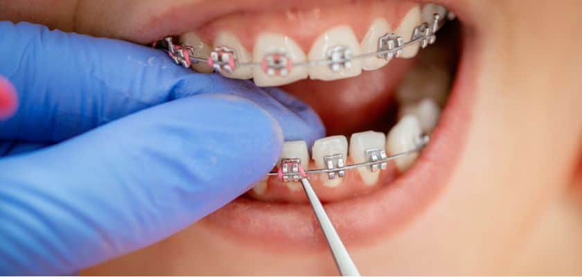 Close-up of a clinician in a blue glove adjusting a bracket on a patient’s braces with a dental instrument.