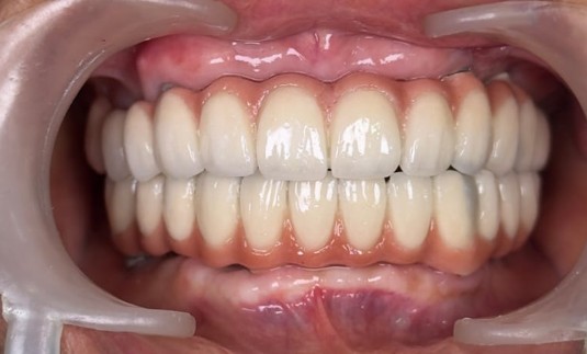Close-up of a full set of upper and lower dentures in a patient’s mouth.