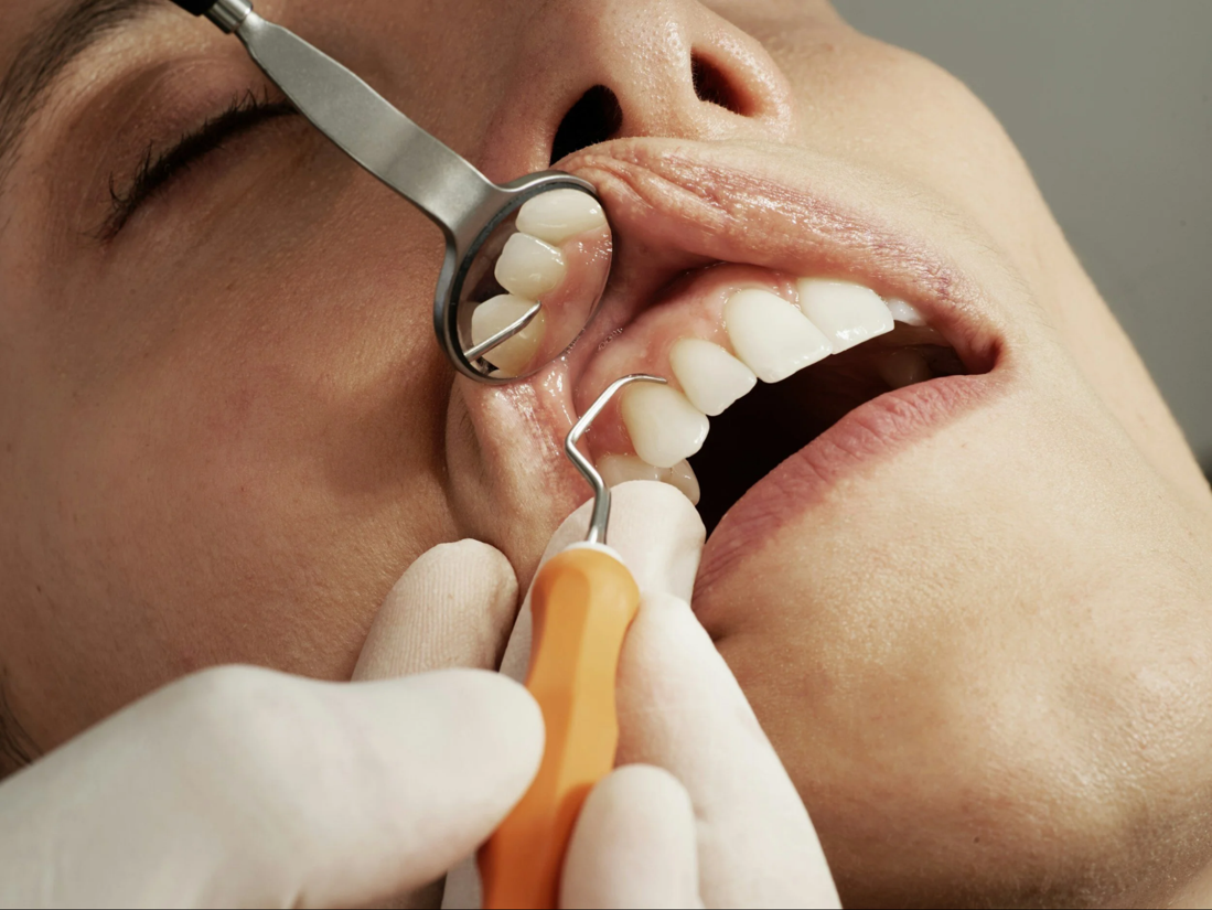 Dental professional with mirror and scaler inspecting a patient's upper teeth during a checkup.
