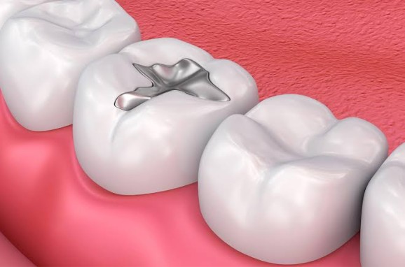 image1 - The Smile Connect Close-up of a molar with a silver amalgam filling among other teeth and pink gums nearby.