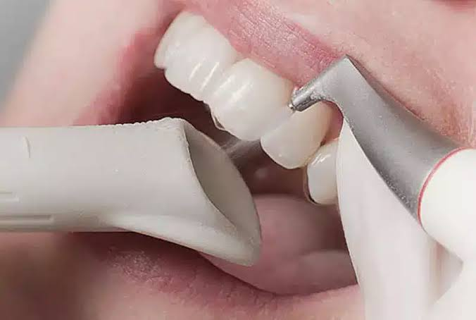 Close-up of a dental cleaning: a scaler and suction device near the upper front teeth.