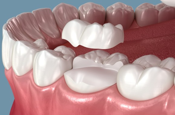 image2 - The Smile Connect 3D dental model showing a white crown being placed on a molar in the upper jaw vision for dental restoration explanation.