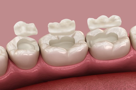 image3 - The Smile Connect Close-up of molars with tooth-colored onlays placed on prepared teeth, showing surrounding pink gum tissue.