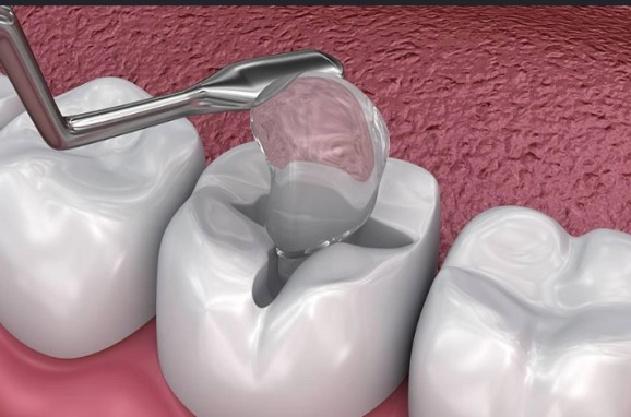 image4 - The Smile Connect Close-up of a dental procedure: a clear resin filling is being placed into a prepared molar cavity with a dental instrument.