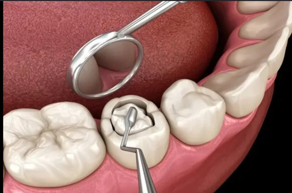 image5 - The Smile Connect Close-up of a lower molar being prepared for a filling; a dental mirror and a handpiece are in use.