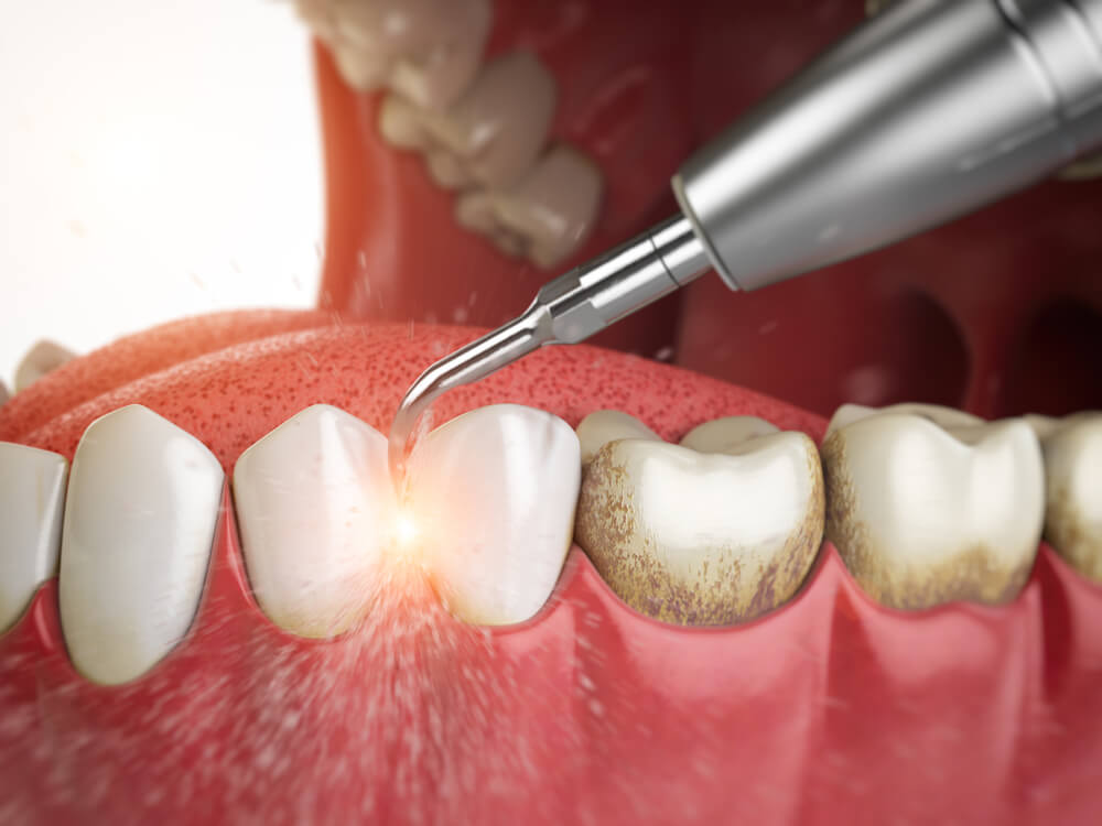 Dental laser used on a front tooth during a dental procedure, with the tip emitting a small bright glow near the gumline.