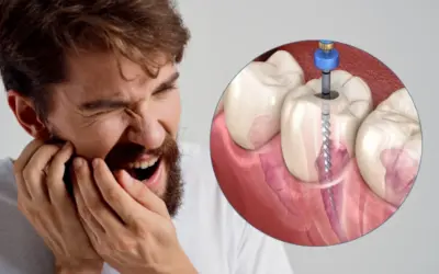 Dental Crown Pain After Root Canal: Causes, Symptoms & When to Seek Treatment