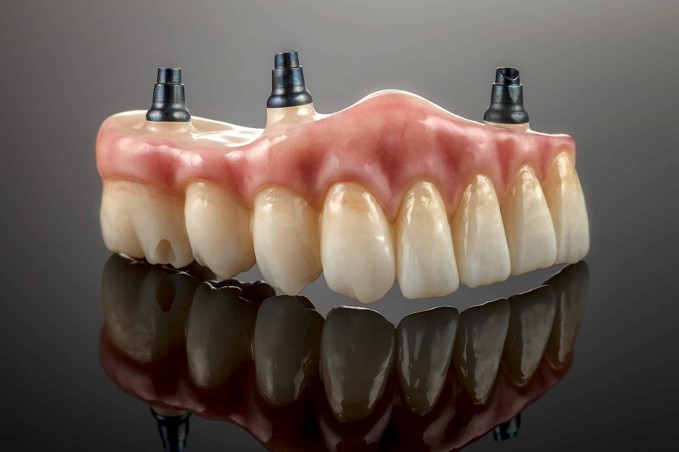 Implant-supported-dentures - The Smile Connect Model of upper jaw with dental implants and prosthetic teeth on pink gums, reflected on a glossy surface