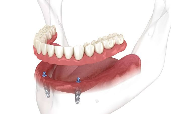 Overdenture 1 - The Smile Connect Lower jaw with an implant-supported denture anchored by four screws into the jawbone.