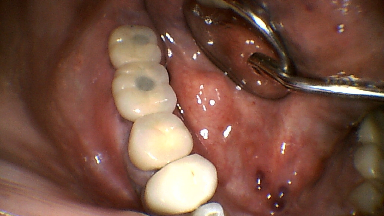 Close-up of lower posterior teeth showing fillings; a dental mirror reflects in the cheek area.