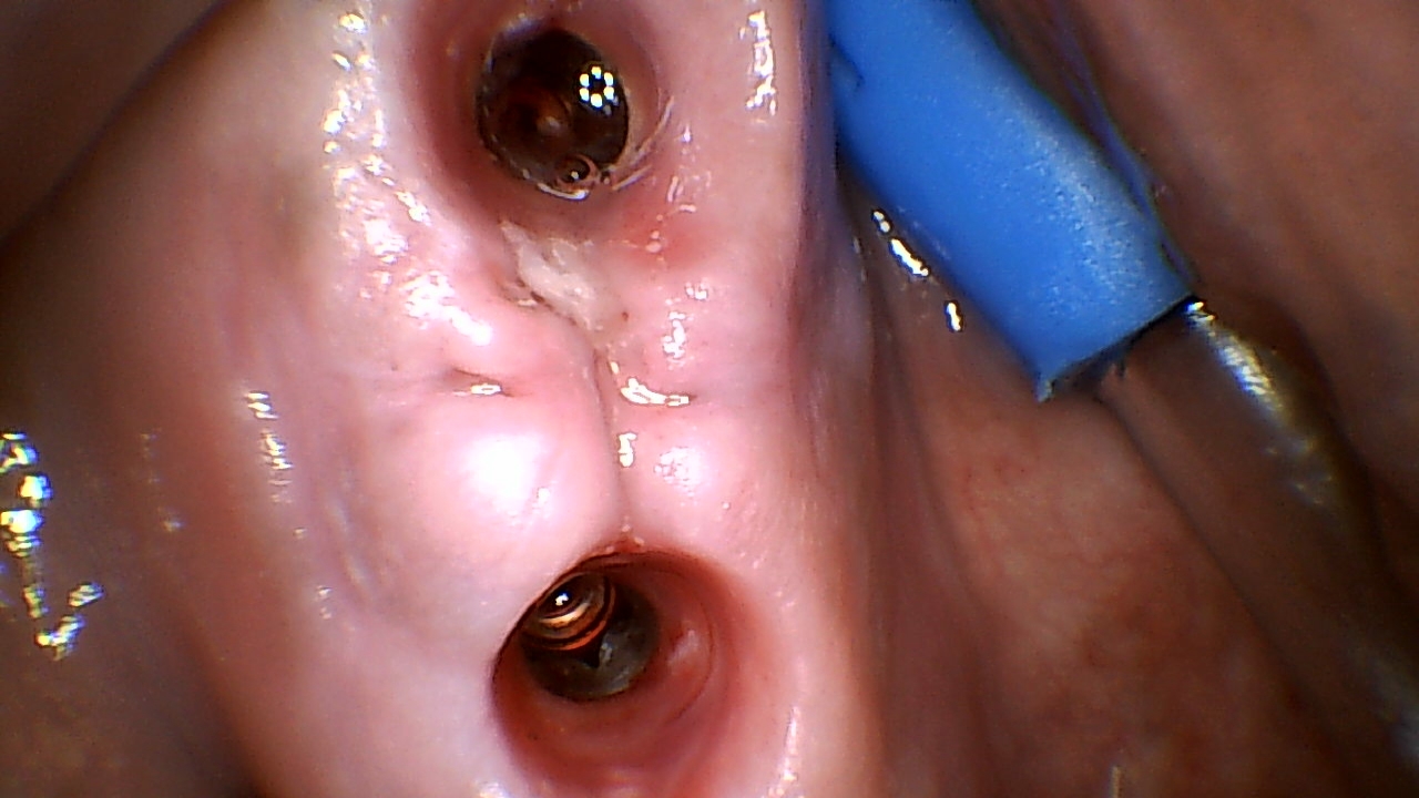 Close-up view of the nasal cavity during a medical suction procedure with a blue instrument in the side of the nose.