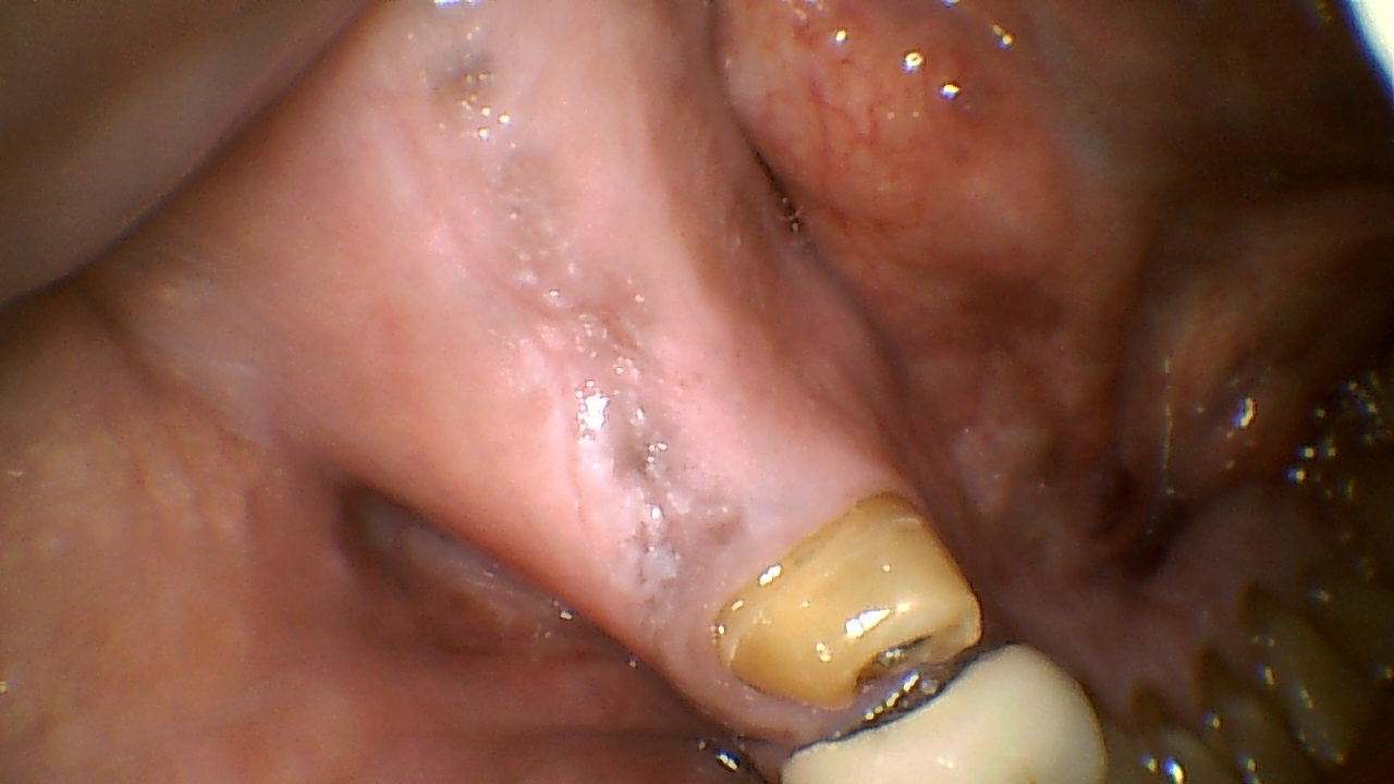 Close-up of a lower tooth with yellowed discoloration and visible decay near the gum line.