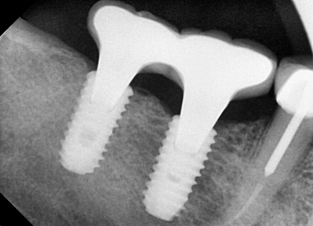 Dental X-ray showing two lower-jaw implants with threaded fixtures and a natural tooth to the right; surrounding bone is visible.