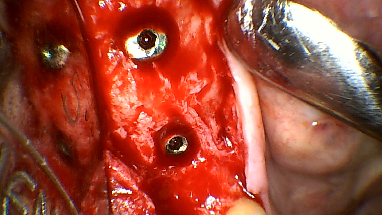 Close-up of a red, bleeding gum with two drilled holes for dental implants in the jawbone.