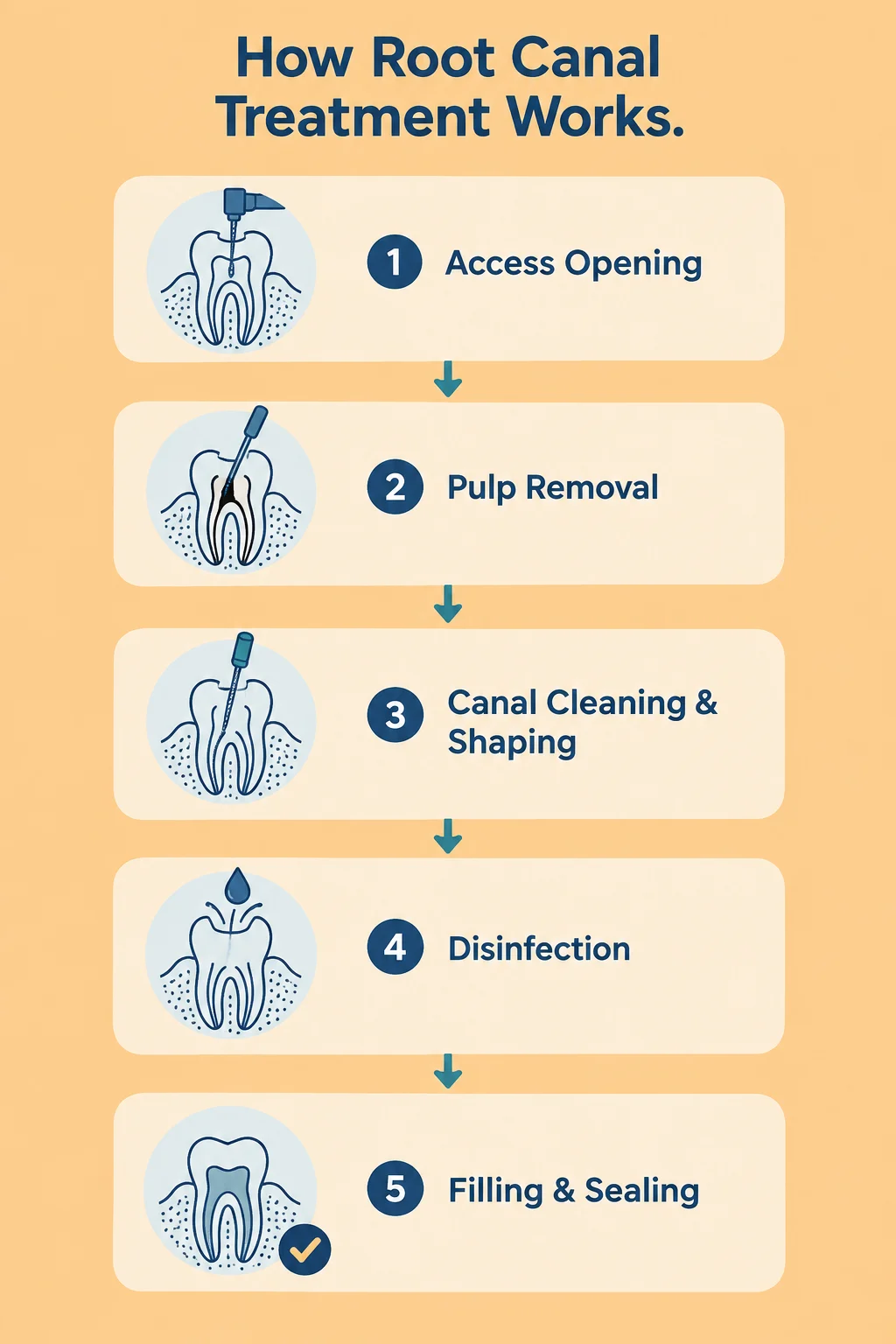 How Does Root Canal Treatment Work Step by Step