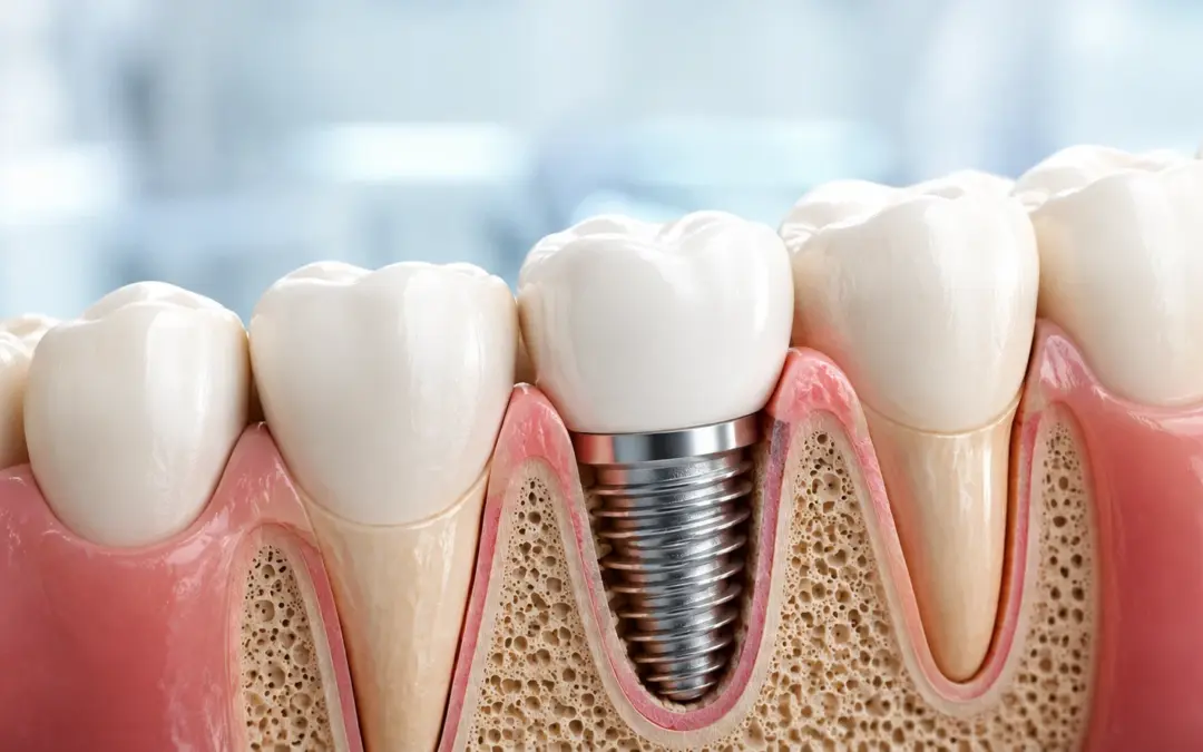 How Long Does a Dental Implant Take to Fully Heal