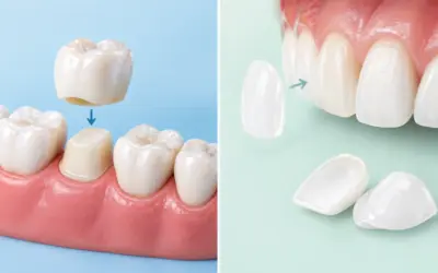 Veneers or Crowns: Which Suits Your Smile Goals?